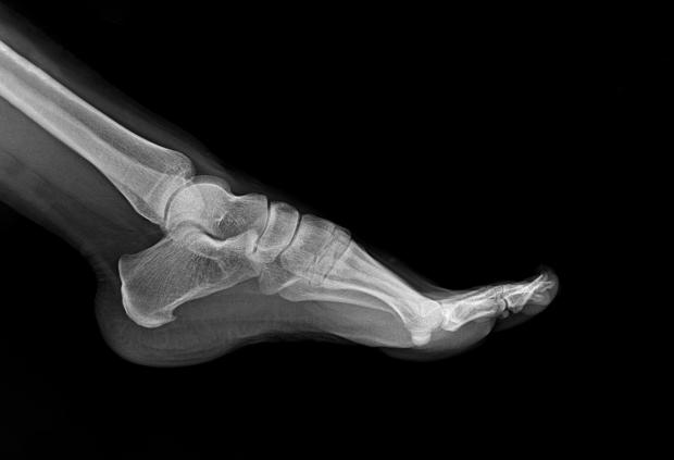 Black and white x-ray image of a foot