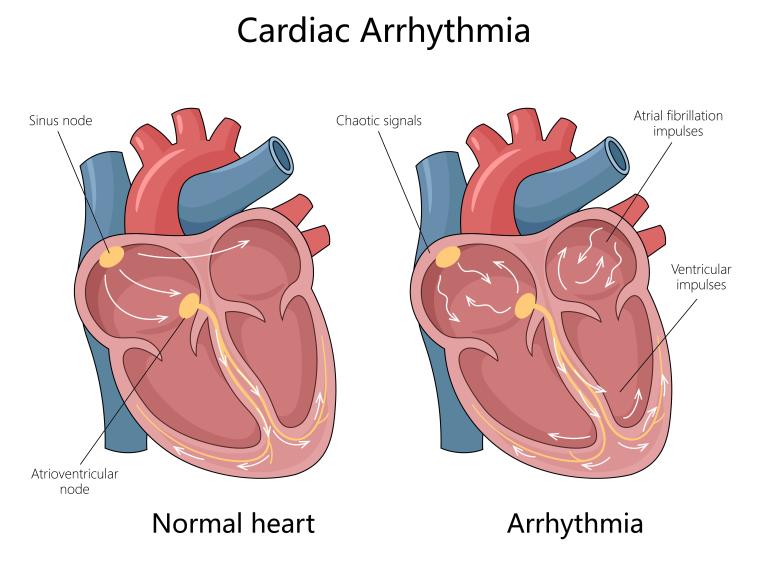 Simple illustration of normal electrical signals in the heart compared to abnormal signals