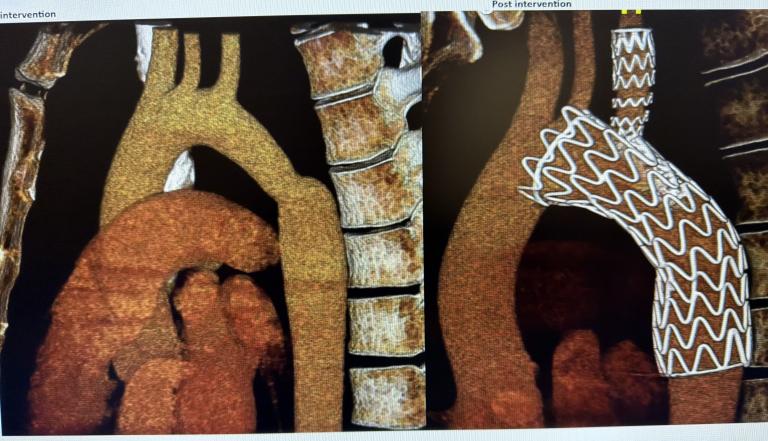 Side-by-side heart scans show Charley's aorta before and after his procedure