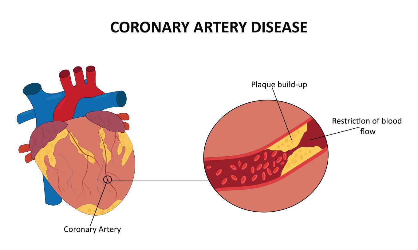 Simple illustration of coronary artery's location on the heart with detail image of clogged coronary artery