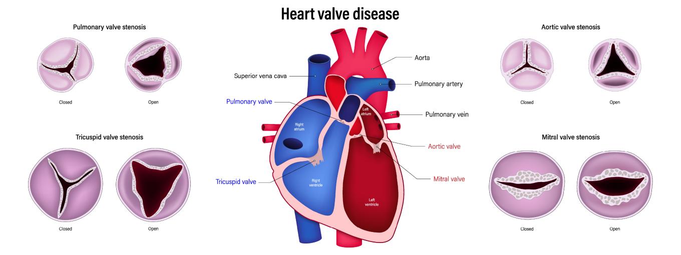 Medical illustration of heart valves and their locations in the heart