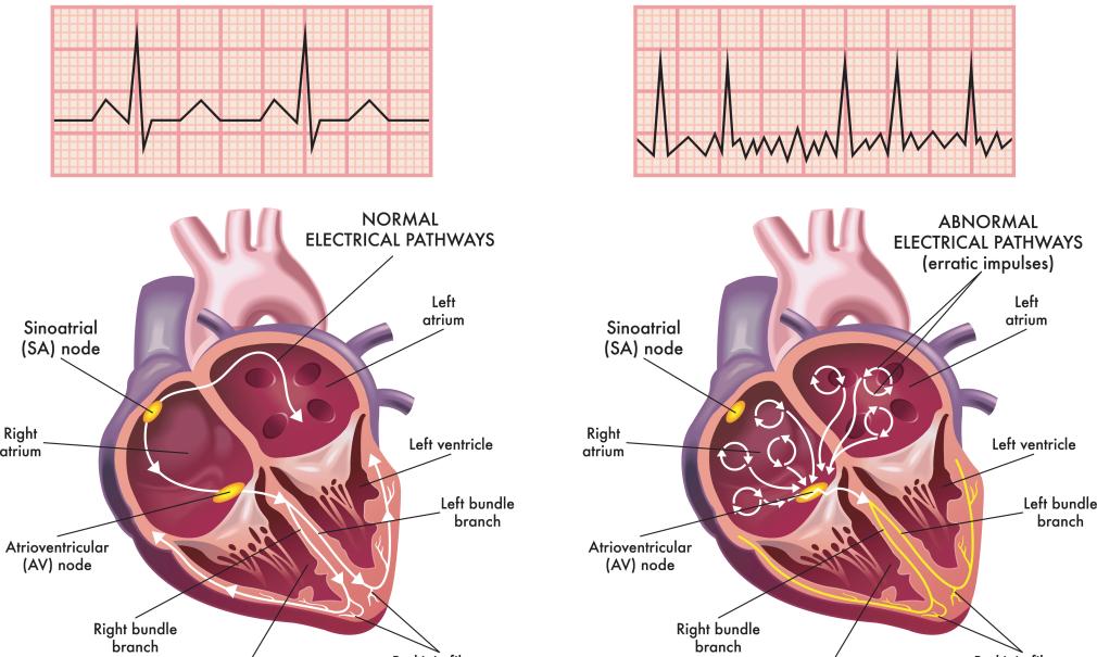 A medical illustration side-by-side of normal heart versus atrial fibrillation