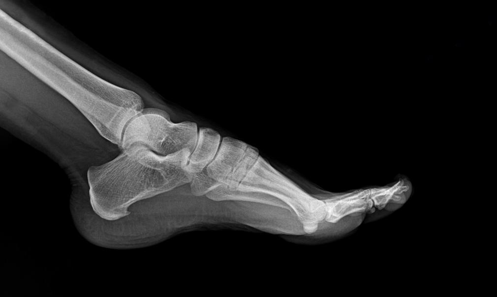 Black and white x-ray image of a foot
