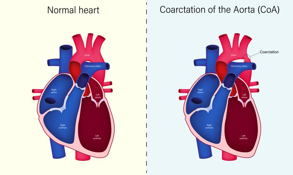 Medical illustration of a healthy heart compared to a heart showing coarctation of the aorta