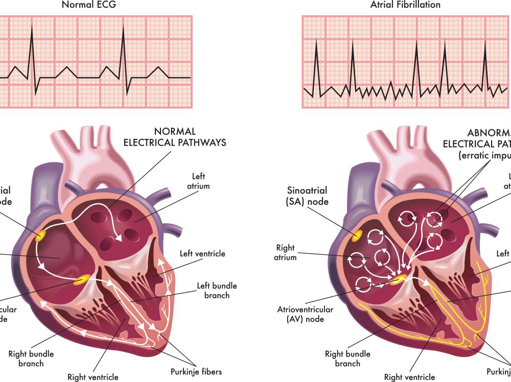 A medical illustration side-by-side of normal heart versus atrial fibrillation