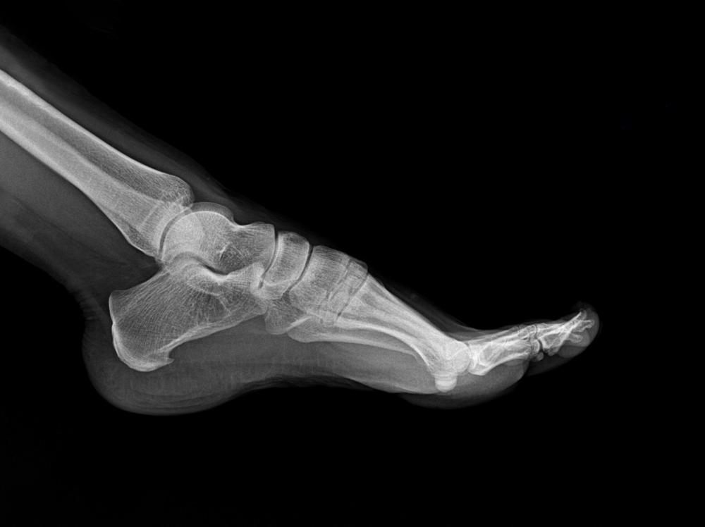 Black and white x-ray image of a foot