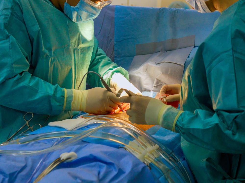 Surgical team performs open heart surgery in hospital operating room