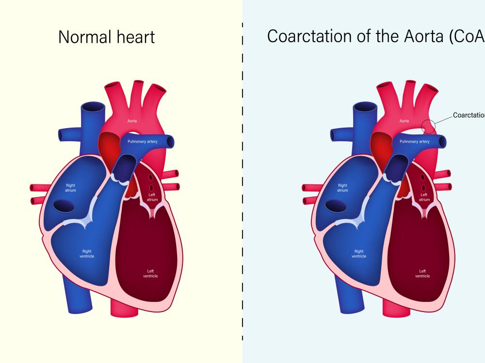 Medical illustration of a healthy heart compared to a heart showing coarctation of the aorta